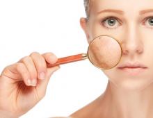 Пигментация кожи: причины, последствия и способы лечения Меланин